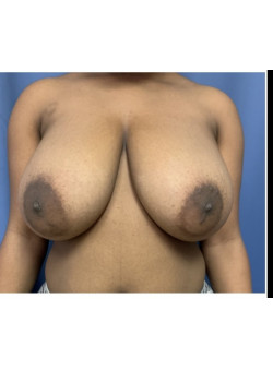 Breast Reduction