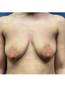 Breast Lift with Implants