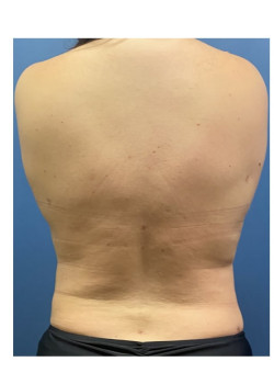Liposuction