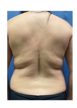 Liposuction
