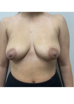 Breast Augmentation