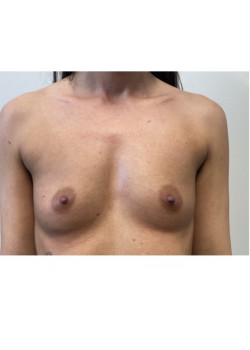Breast Augmentation