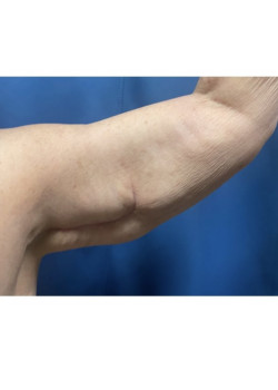 Mini Brachioplasty