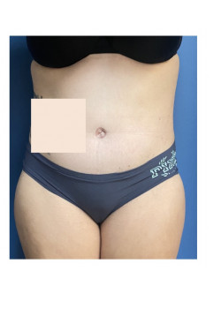 Tummy Tuck with Liposuction