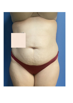 Tummy Tuck with Liposuction