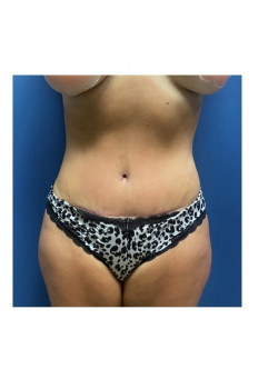 Tummy Tuck with Liposuction