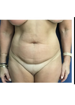 Tummy Tuck with Liposuction