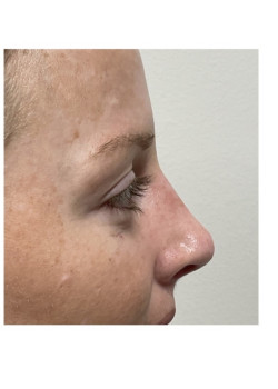 Rhinoplasty