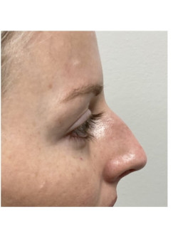 Rhinoplasty