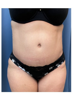 Tummy Tuck with Liposuction