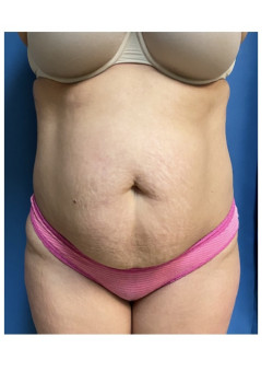 Tummy Tuck with Liposuction