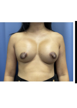 Breast Augmentation