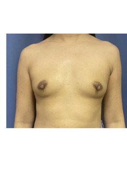 Breast Augmentation