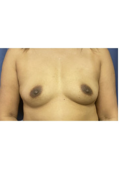 Breast Augmentation
