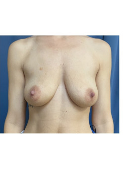 Breast Augmentation
