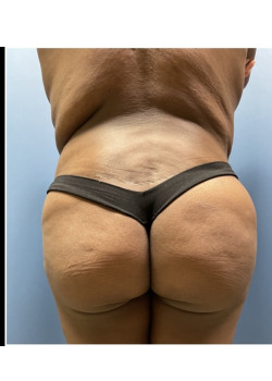 Tummy Tuck with Brazilian Butt Lift