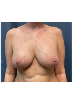 Breast Lift with Implants
