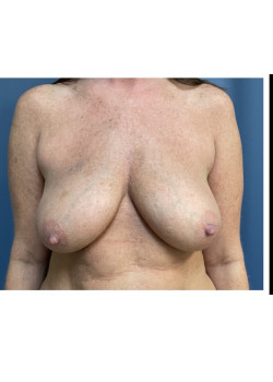 Breast Lift with Implants