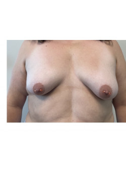 Breast Lift with Implants