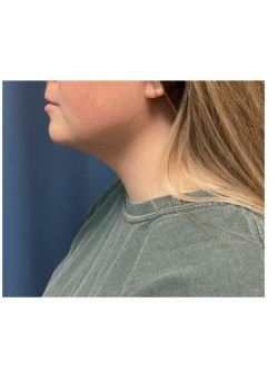 Liposuction