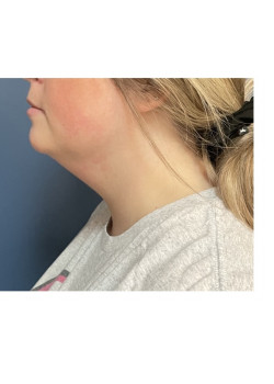 Liposuction